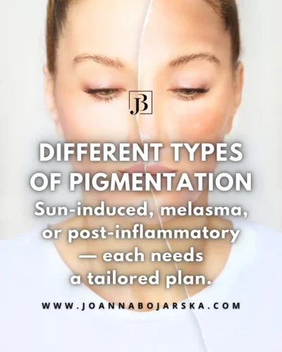 Understanding Hyperpigmentation - Photo 3 - Joanna Bojarska Beauty Expert
